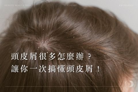頭皮屑很多怎麼辦?讓你一次搞懂頭皮屑!